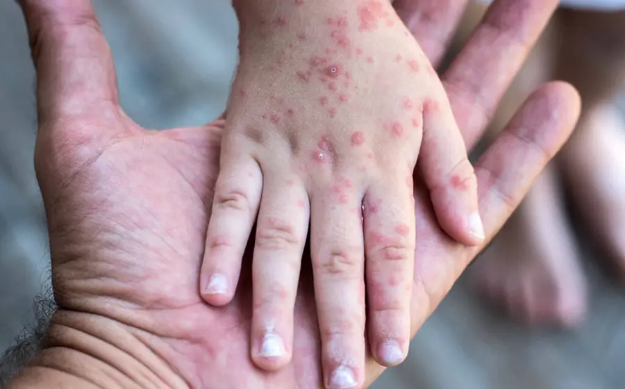 Posible repunte de sarampión pone en alerta a autoridades de salud.