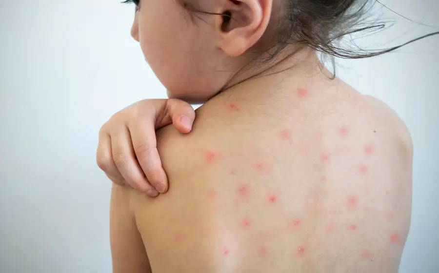 Autoridades de salud inician vacunación infantil contra el sarampión como parte del cerco epidemiológico activado por un brote en el Istmo.