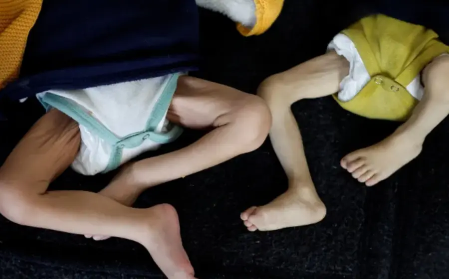 Un recién nacido en un hospital de Gaza presenta malformaciones congénitas, como reflejo de la crisis sanitaria por nacimientos con complicaciones en la región.
