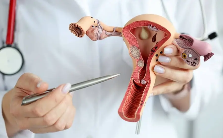 Ilustración médica que muestra el crecimiento anormal de células en el cuello uterino, origen del cáncer cervicouterino, enfermedad prevenible con detección oportuna.