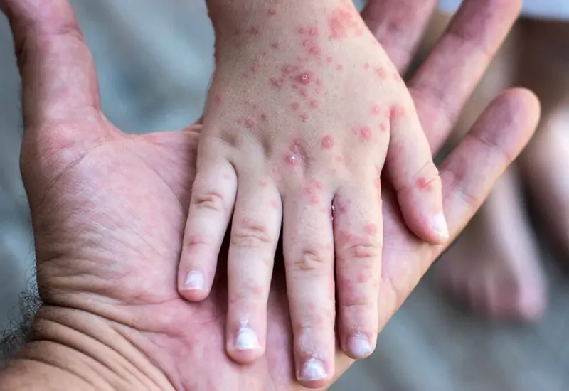 Posible repunte de sarampión pone en alerta a autoridades de salud.