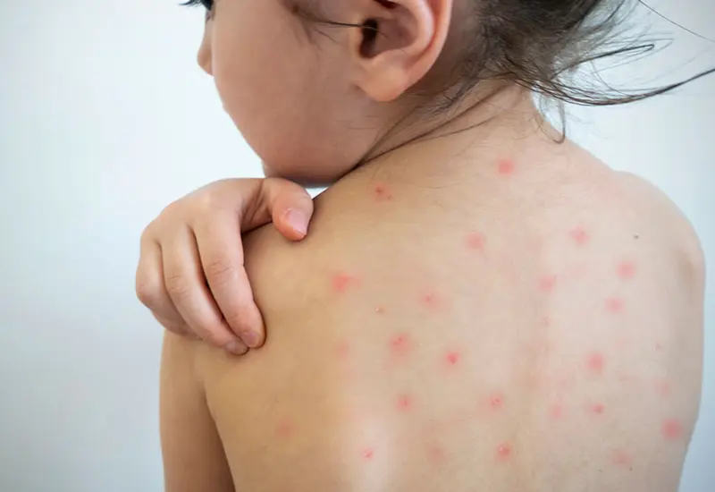 Autoridades de salud inician vacunación infantil contra el sarampión como parte del cerco epidemiológico activado por un brote en el Istmo.